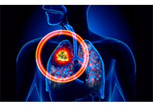 Individualized Medication Guidance for Cancer (118 Genes)